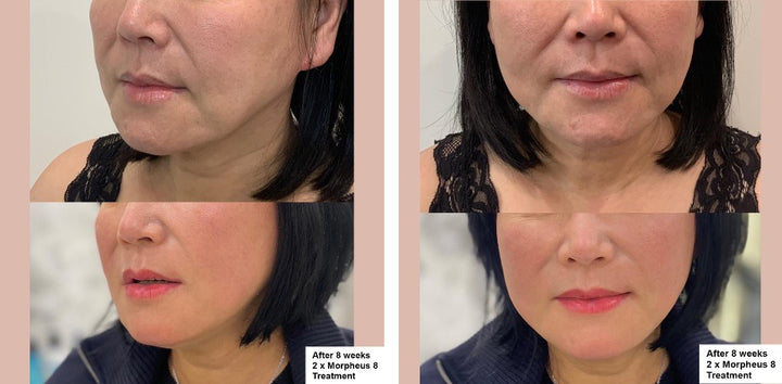 Morpheus8 Before and After_Lift Aesthetics Sydney